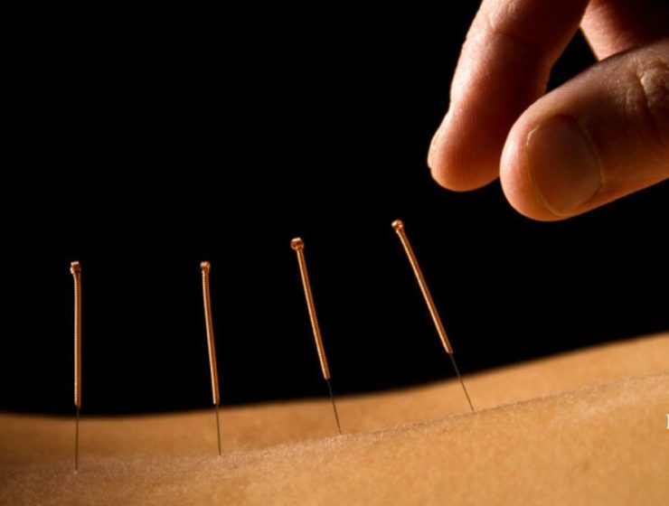 Tratamentul prin acupunctură: Riscuri și beneficii